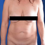 Tummy Tuck Before & After Patient #1290
