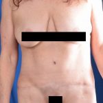 Tummy Tuck Before & After Patient #1290