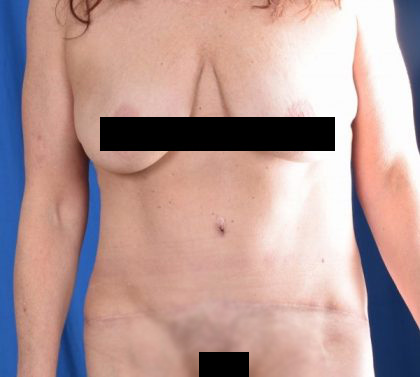 Tummy Tuck Before & After Patient #1290