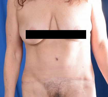 Tummy Tuck Before & After Patient #1290