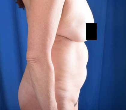 Tummy Tuck Before & After Patient #1290