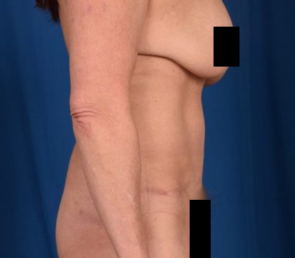 Tummy Tuck Before & After Patient #1290