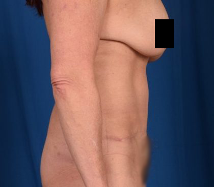 Tummy Tuck Before & After Patient #1290