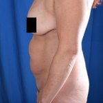 Tummy Tuck Before & After Patient #1290