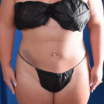 Liposuction Before & After Patient #1261