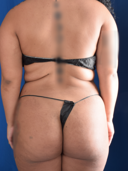 Liposuction Before & After Patient #1254