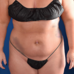 Liposuction Before & After Patient #1261