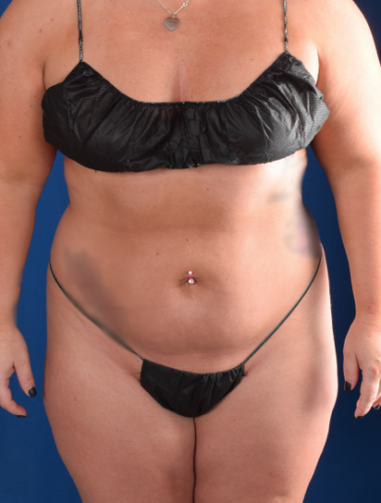 Liposuction Before & After Patient #1261