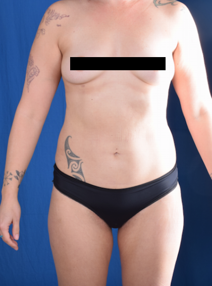 Liposuction Before & After Patient #1266