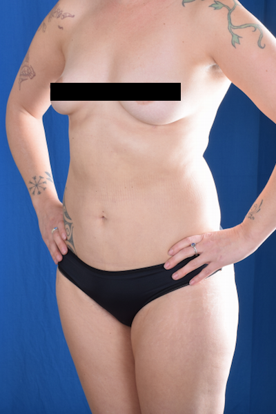 Liposuction Before & After Patient #1266
