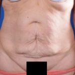 Tummy Tuck Before & After Patient #1297