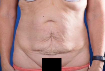 Tummy Tuck Before & After Patient #1297