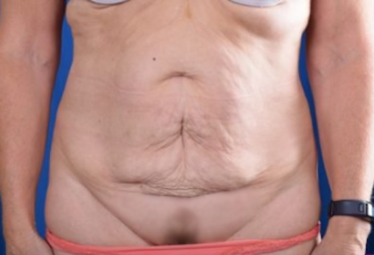 Tummy Tuck Before & After Patient #1297