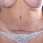 Tummy Tuck Before & After Patient #1297