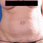 Tummy Tuck Before & After Patient #1276