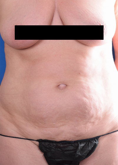 Tummy Tuck Before & After Patient #1276