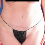 Tummy Tuck Before & After Patient #1276