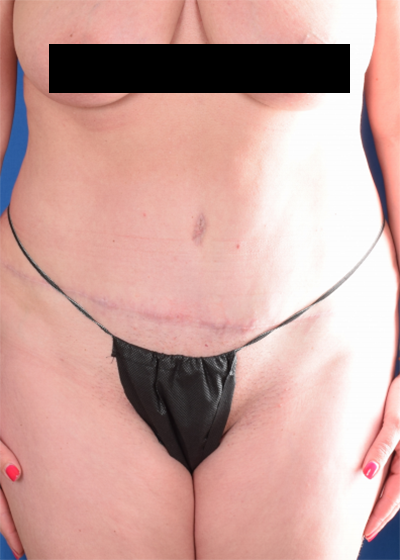 Tummy Tuck Before & After Patient #1276