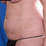 Tummy Tuck Before & After Patient #1276