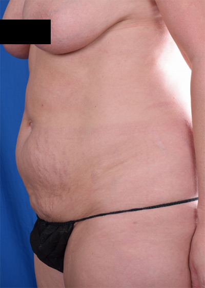 Tummy Tuck Before & After Patient #1276