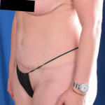 Tummy Tuck Before & After Patient #1276