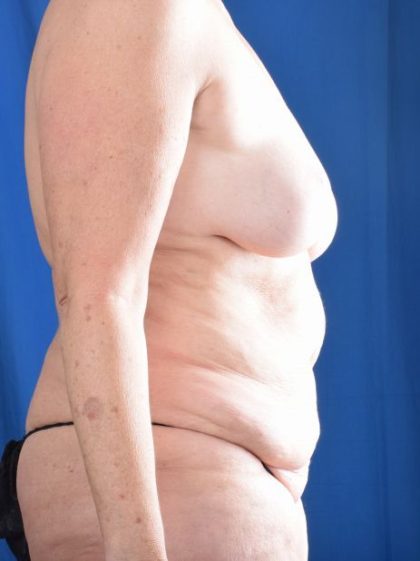 Tummy Tuck Before & After Patient #1283