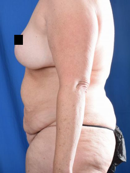 Tummy Tuck Before & After Patient #1283