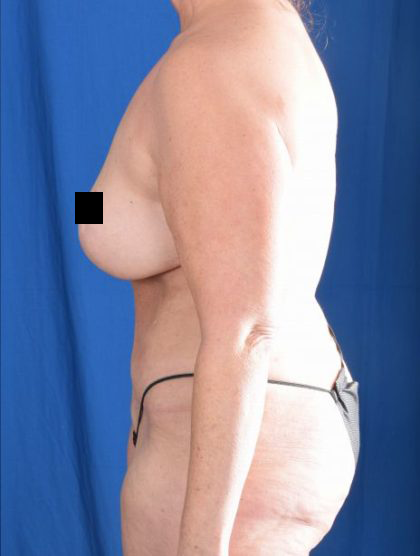 Tummy Tuck Before & After Patient #1283