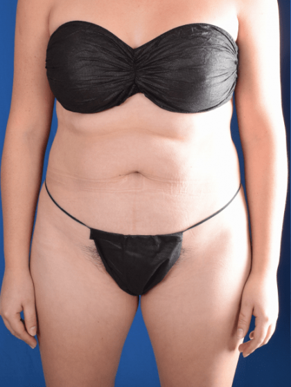 Liposuction Before & After Patient #1396
