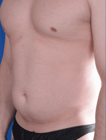 Liposuction Before & After Patient #1399