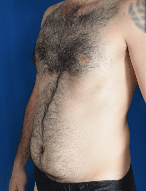 Liposuction Before & After Patient #1414