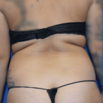 Liposuction Before & After Patient #1423