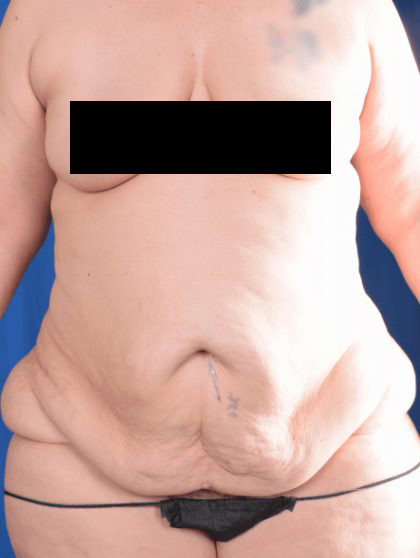 Tummy Tuck Before & After Patient #1441