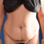 Tummy Tuck Before & After Patient #1453