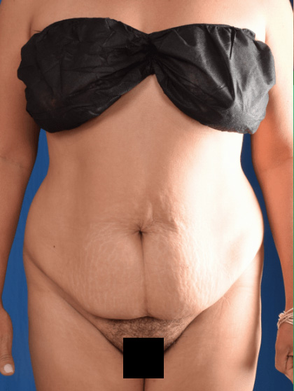 Tummy Tuck Before & After Patient #1453