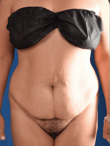 Tummy Tuck Before & After Patient #1453
