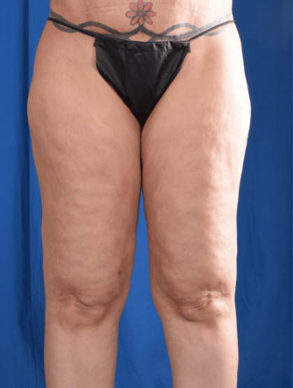 Liposuction Before & After Patient #1333