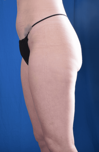 Liposuction Before & After Patient #1341