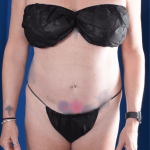 Liposuction Before & After Patient #1376