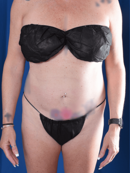 Liposuction Before & After Patient #1376