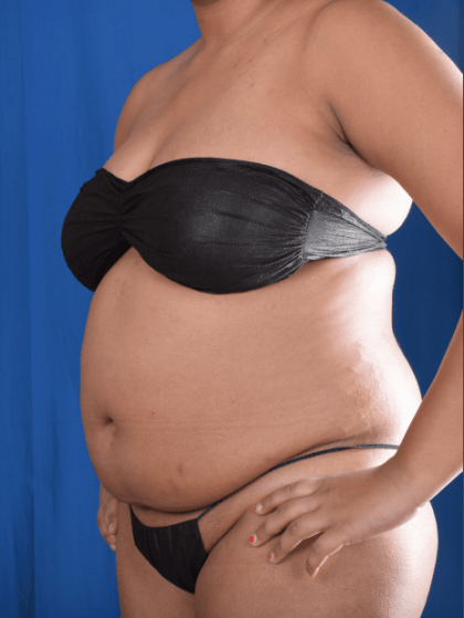 Liposuction Before & After Patient #1387