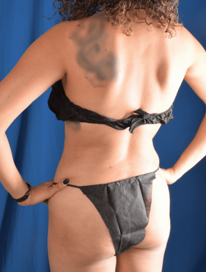 Liposuction Before & After Patient #1409