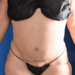 Tummy Tuck Before & After Patient #1441