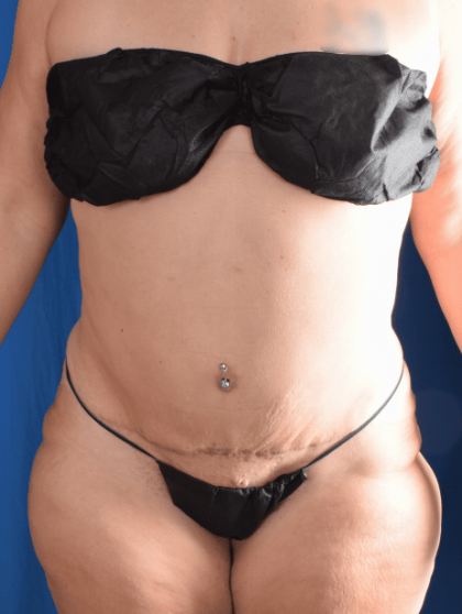 Tummy Tuck Before & After Patient #1441