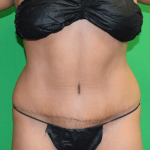 Tummy Tuck Before & After Patient #1453