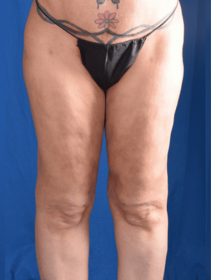 Liposuction Before & After Patient #1333