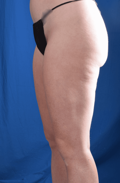 Liposuction Before & After Patient #1341