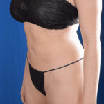 Liposuction Before & After Patient #1365