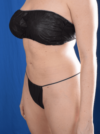 Liposuction Before & After Patient #1365
