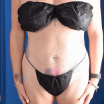 Liposuction Before & After Patient #1376